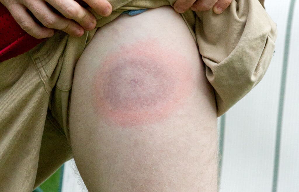 Tick-Borne Diseases are Hard to Diagnose